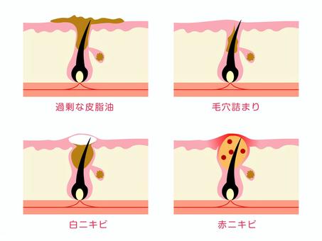 背中ニキビに悩む人向け!おすすめアイテム4選|背中ニキビの原因とは?